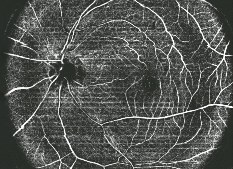 Huvitz OCTavius Upgrade Angiographie